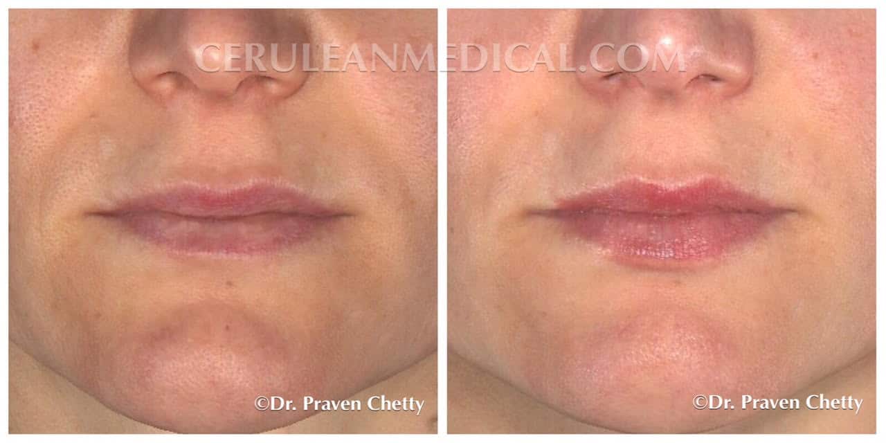 Lip Enhancement Before and After Photo 3 at Cerulean Medical Institute in Kelowna BC
