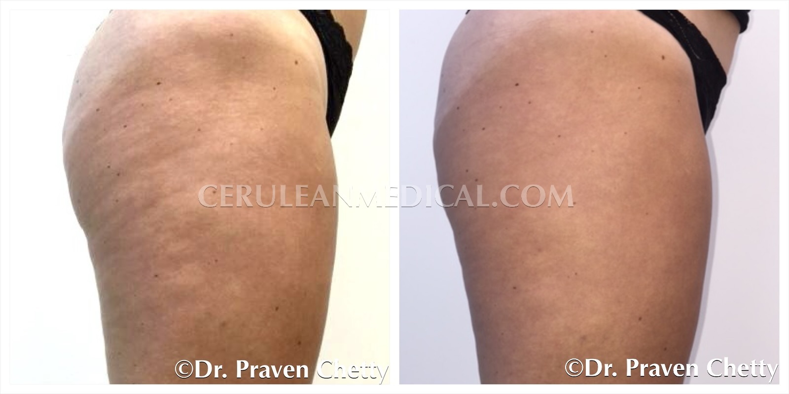 Cellulite Reduction Treatment Before and After Photo 2 at Cerulean Medical Institute in Kelowna BC